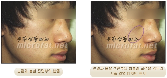 [두한성형외과 지방이식] - [귀족수술과 인디언밴드 교정] 관련 이미지 6