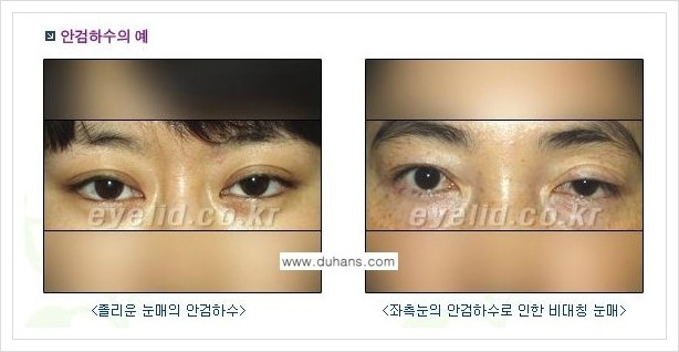 [두한성형외과 경쟁력 쌍꺼풀 재수술, 극한 눈재수술] - [안검하수 종류 안내] 관련 이미지 1