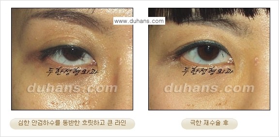 ⁠⁠⁠⁠[두한성형외과 성형 FOCUS] - [정상적인 눈매로의 복원 극한재수술 경우 ①] 관련 이미지 5