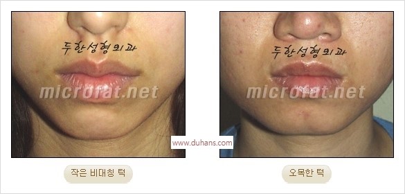 [두한성형외과 경쟁력 안면윤곽 교정] - [자연스럽고 균형있는 턱으로의 복원 미세지방이식과 간편 사각턱 보톡스 안내] 관련 이미지 3