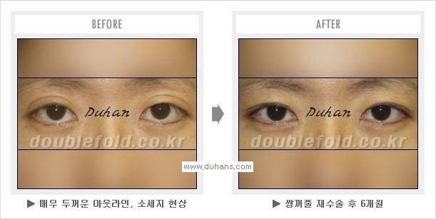 [두한성형외과 경쟁력 쌍꺼풀 재수술, 극한 눈재수술] - [두툼한 소세지 쌍꺼풀 라인 교정] 관련 이미지 8