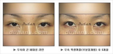 Best Place for Double Eyelid Revision Surgery, Duhan Plastic Surgery - Partial Incision Eye Revision Surgery image 27