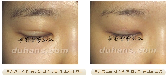 [두한성형외과 쌍커풀재수술] - [쌍커풀재수술 수술방법과 쌍커풀재수술 성공요건] 관련 이미지 41
