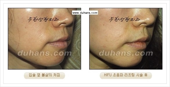 [두한성형외과 경쟁력 주름성형] - [HIFU 초음파 리프팅 주름교정술 안내 2.] 관련 이미지 17
