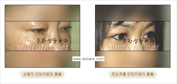 [두한성형외과 경쟁력 "지방제거"] - [눈 지방제거 1.] 관련 이미지 2