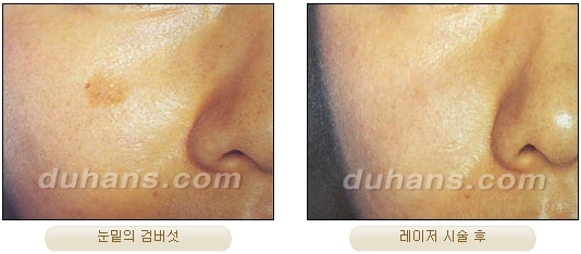 Duhan Plastic Surgery Laser Treatment - Mole Removal, Spot Removal, Melasma, Blemishes, Hyperpigmentation, Skin Tone Improvement, Elasticity Improvement, Skin Texture Improvement image 35