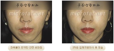 [두한성형외과 얼굴지방이식] - [볼지방이식] 관련 이미지 28