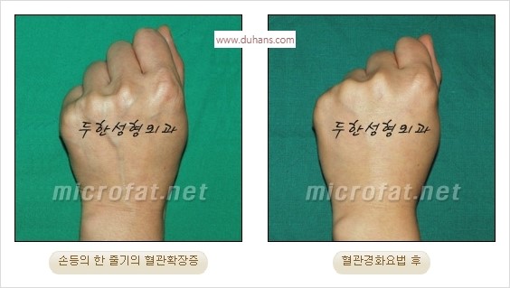 [두한성형외과 경쟁력 정맥류] - [손, 팔의 정맥확장증(혈관확장증) 치료 방법 안내] 관련 이미지 13