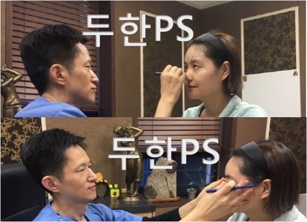 [두한ps]-#눈위,#눈밑,#이마,#관자(#측두부)#지방이식으로 얼굴 볼륨감 살리기 , #꺼진눈꺼풀,#눈꺼풀지방이식 관련 이미지 2
