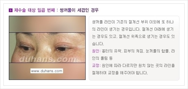 [두한성형외과 경쟁력 쌍꺼풀 재수술(극한 재수술)] - [쌍꺼풀 재수술 대상의 안내] 관련 이미지 7