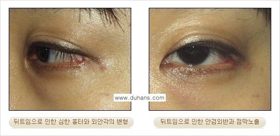 [두한성형외과 No.1 경쟁력] - [앞트임 복원 수술, 뒤트임 복원 수술] 관련 이미지 9