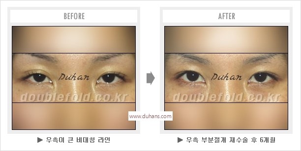 [두한성형외과 경쟁력 눈성형] - [나에게 맞는 어울리는 쌍꺼풀 라인] 관련 이미지 47