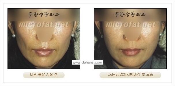 [두한성형외과 경쟁력 미세지방이식] - [상표등록 "Col-fat(콜펫) 지방이식"의 장점 안내] 관련 이미지 8