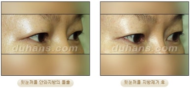 [DuHan Plastic Surgery Double Eyelid Surgery] - [Frequently Asked Questions and Answers About Eye Plastic Surgery] image 34