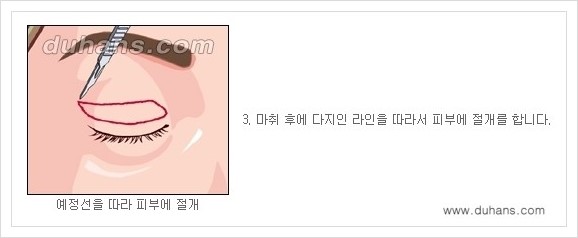 [두한성형외과 경쟁력 눈성형] - [상큼하고 환한 눈매! 상안검 성형(윗눈꺼풀 처짐) 안내] 관련 이미지 3