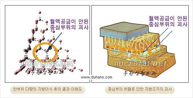 ⁠⁠[두한성형외과 경쟁력 미세지방이식] - [3차원 입체지방이식, 2차원 평면지방이식] 관련 이미지 4