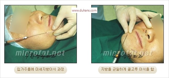 [두한성형외과 경쟁력 미세지방이식] - [타 병원의 지방이식 부작용 교정 - 정교한 마이크로 지방이식, 흡입 안내] 관련 이미지 29