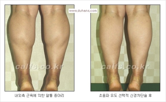 [두한성형외과 Dr. 컬럼] - [종아리 근육퇴축술로 가장 선호하는 비절개 초음파 유도 선택적 신경차단술] 관련 이미지 14
