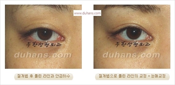 [두한성형외과 경쟁력 눈성형] - [풀려버린 쌍꺼풀 교정 방법] 관련 이미지 2