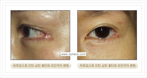 [두한성형외과 경쟁력 쌍꺼풀 재수술, 극한 눈재수술] - [뒤트임 부작용과 뒤트임 교정수술 방법 안내] 관련 이미지 4