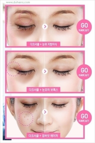 ​﻿[두한성형외과 경쟁력 눈밑성형] - [눈밑 다크써클 개선 방법] 관련 이미지 12