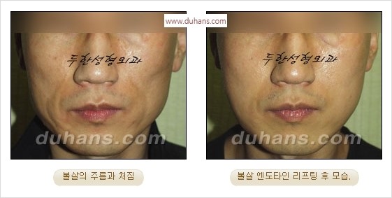 [두한성형외과 경쟁력 주름성형] - [간단하고 부작용 없는 자연스러운 주름제거 방법] 관련 이미지 27