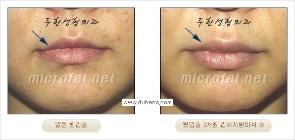 [두한성형외과 경쟁력 미세지방이식] - [입체 미세지방이식으로 주름을 펴면서 볼륨감 있는 입술 만들기] 관련 이미지 6