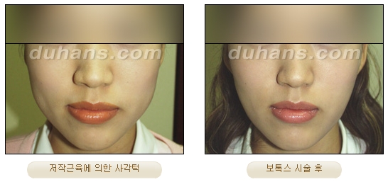 [두한성형외과 보톡스시술] - [사각턱 보톡스 안내] 관련 이미지 5