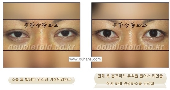 [두한성형외과 경쟁력 눈성형] - [안검하수(졸리운 눈매)의 종류와 교정 방법 안내] 관련 이미지 7