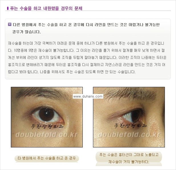 [두한성형외과 극한 재수술, 쌍꺼풀 재수술] - [쌍꺼풀 재수술에서 극복해야 할 극한의 상황과 문제] 관련 이미지 11