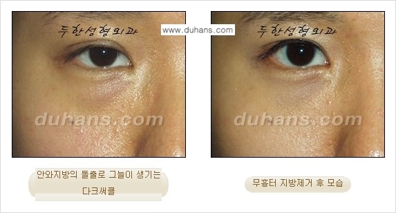 [두한성형외과 젊은 눈매 안검성형] - [눈밑 지방제거의 수술 전후 안내 ①] 관련 이미지 15