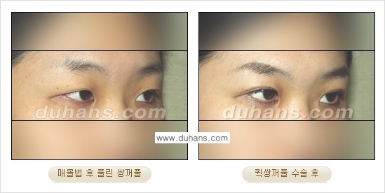 [두한성형외과 경쟁력 눈성형]- [최소 부기로 일상의로의 복귀가 가능한 아름다운 퀵쌍꺼풀(부분절개법) 수술] 관련 이미지 14