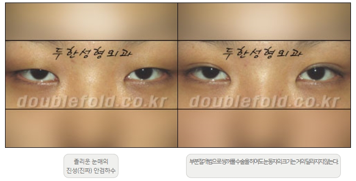 [Ptosis, Duhan Plastic Surgery] - [Sleepy-Looking Eyes, Ptosis Eye Correction] image 2