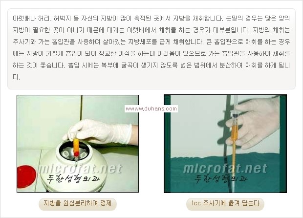 [두한성형외과 경쟁력 눈밑성형] - [눈밑 미세지방이식으로 다크써클 치료] 관련 이미지 8