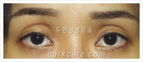 [두한성형외과 경쟁력 눈밑성형] - [다크써클 + 눈위 지방이식 콤비 프로그램] 관련 이미지 2