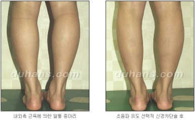 [두한성형외과 종아리 퇴축] - [종아리 퇴축술 재발 재수술] 관련 이미지 24