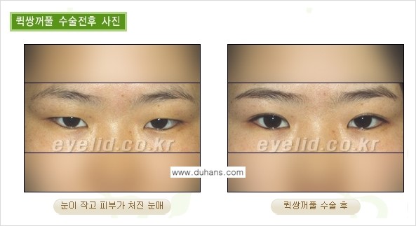 [두한성형외과 성형 FOCUS] - [퀵쌍꺼풀 수술 ④] 관련 이미지 3