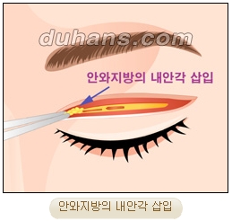 눈성형잘하는곳 두한성형외과 - 겹쌍꺼풀 관련 이미지 20