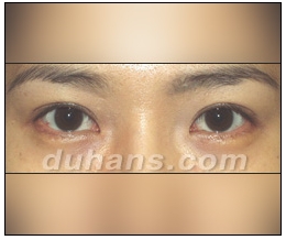 Candidates for Double Eyelid Revision Surgery: Unattractive Double Eyelids, Beautiful Double Eyelids image 41