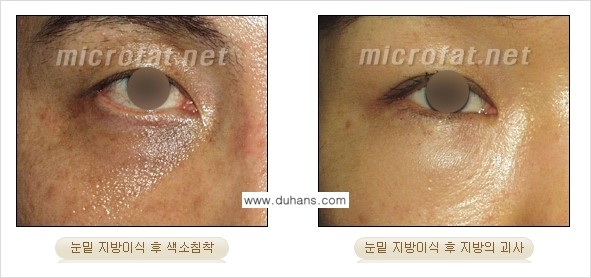 [두한성형외과 경쟁력 "미세지방이식"] - [미세지방이식의 잘못된 지식 1.] 관련 이미지 12