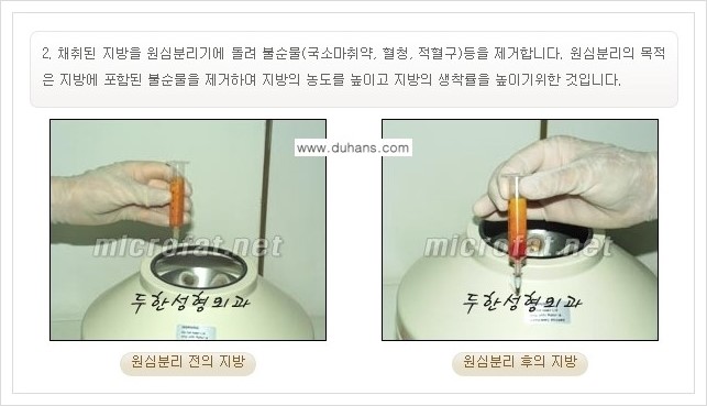 [두한성형외과 경쟁력 지방이식] - [입가주름, 팔자주름 미세지방이식의 안내] 관련 이미지 5