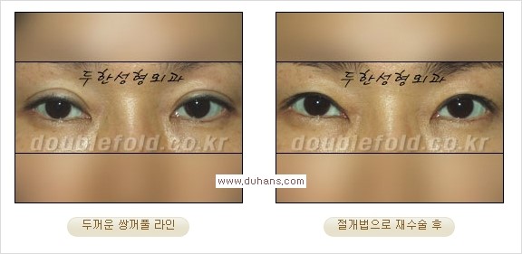 [두한성형외과 경쟁력 쌍꺼풀 재수술] - [쌍꺼풀 재수술 과정] 관련 이미지 72