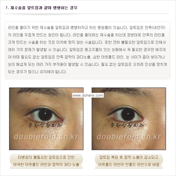[두한성형외과 경쟁력 쌍꺼풀 재수술(눈재수술)] - [쌍꺼풀 재수술(눈재수술)의 실패의 원인 분석] 관련 이미지 2