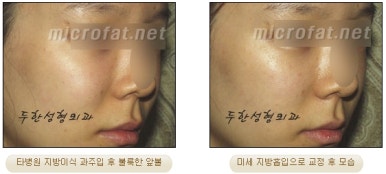 [두한성형외과 얼굴지방이식] - [볼지방이식] 관련 이미지 41