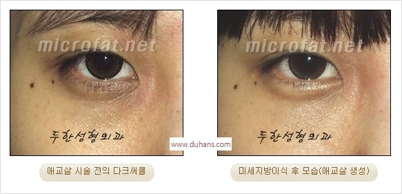 [두한성형외과 경쟁력 미세지방이식] - [애교살 필러 시술의 부작용 교정] 관련 이미지 13