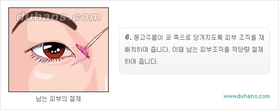 [두한성형외과 경쟁력 눈성형] - [몽고주름 제거수술, 앞트임 수술 안내] 관련 이미지 12