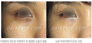 [두한성형외과 다크서클 수술방법] - [NO흉터 눈밑지방제거] 관련 이미지 19