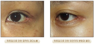 [Duhan Plastic Surgery Eyelid Surgery] - [Epicanthoplasty, Medial Canthoplasty] image 15