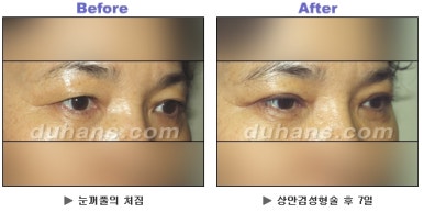 [Duhan Plastic Surgery Blepharoplasty] - [Upper Eyelid Surgery for a Younger-Looking Eye Area] image 11