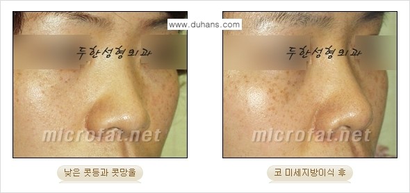 [두한성형외과 경쟁력 미세지방이식] - [두한성형외과 Col-fat(콜펫) 지방이식으로 교정이 가능한 부위 안내] 관련 이미지 6